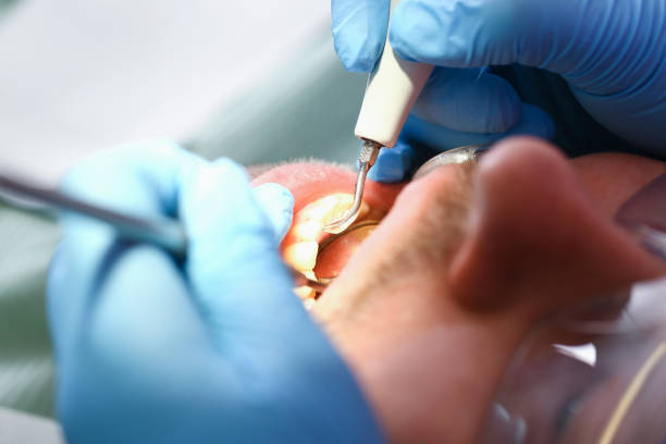 Best Emergency Tooth Extraction in Northfield, OH